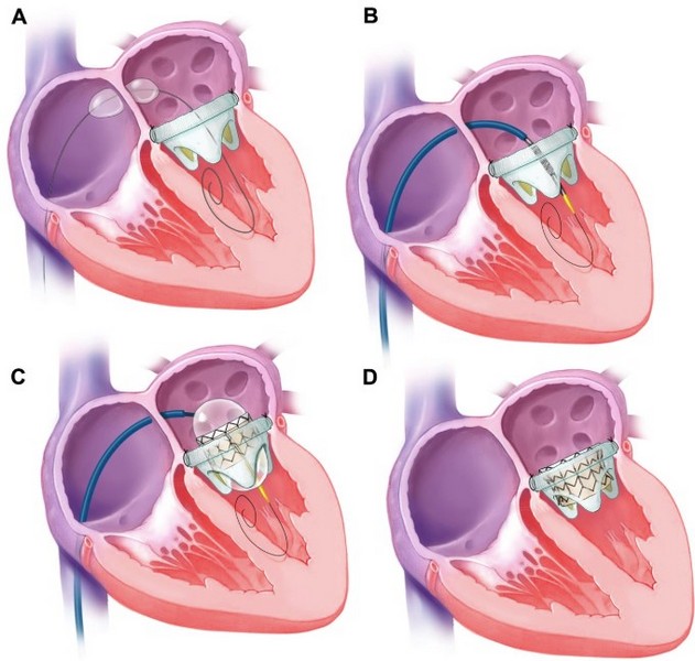 AUBMC Performs the First Transseptal Percutaneous Mitral Valve in Valve in the Middle East